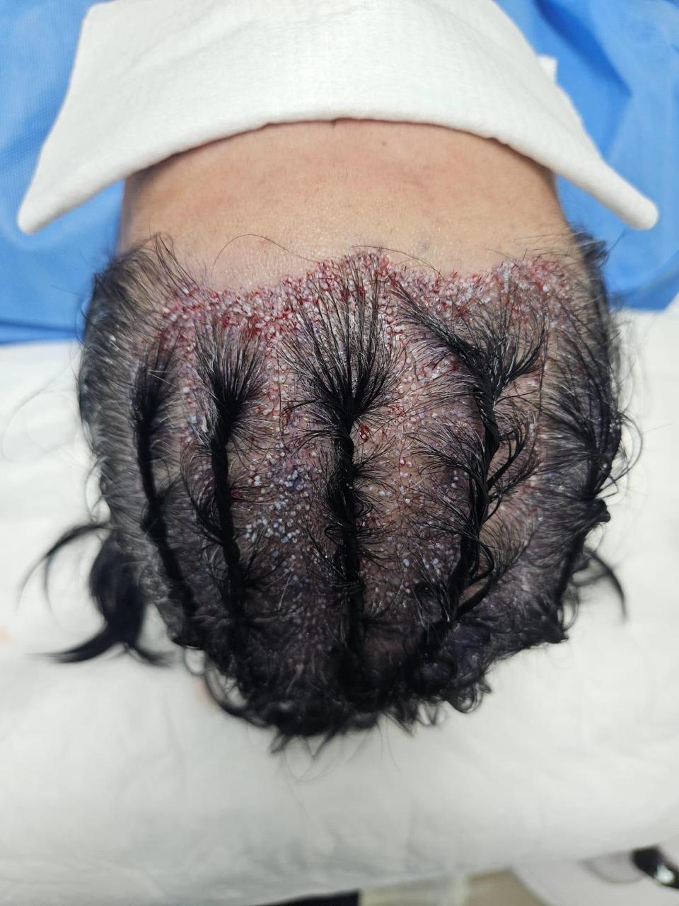 Pós-implante capilar