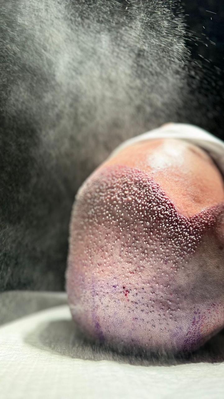 Pós-operatório spray