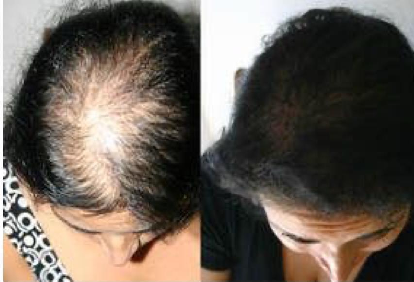 Antes e depois - alopecia feminina