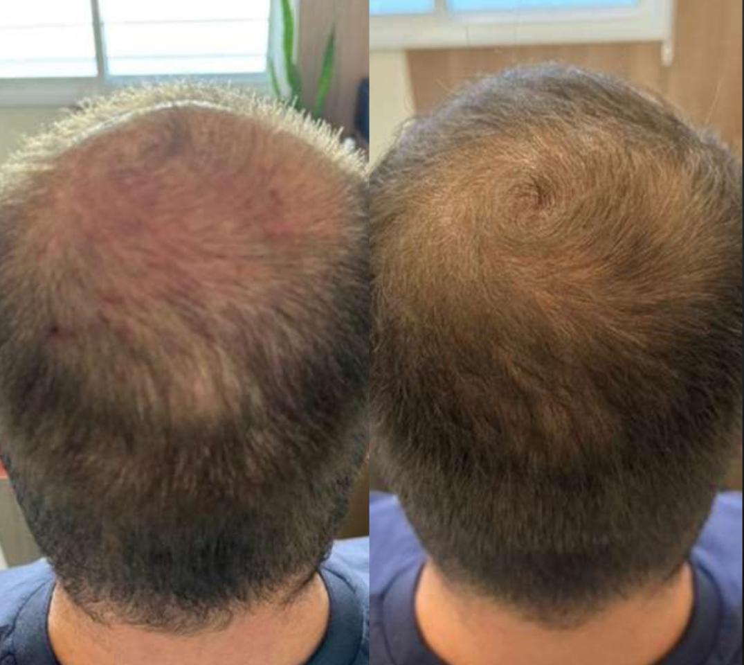 Antes e depois masculino