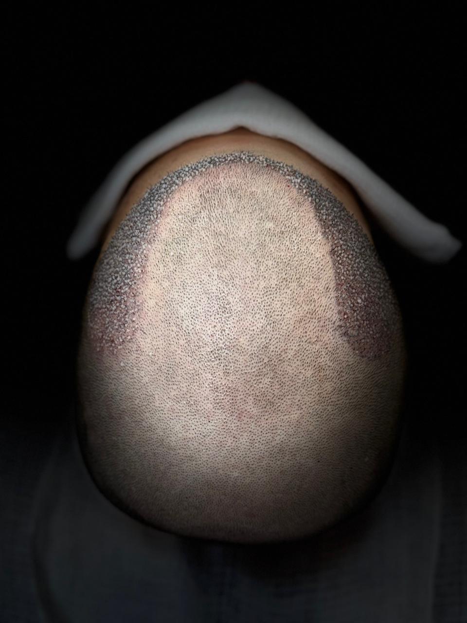 Área receptora antes do transplante